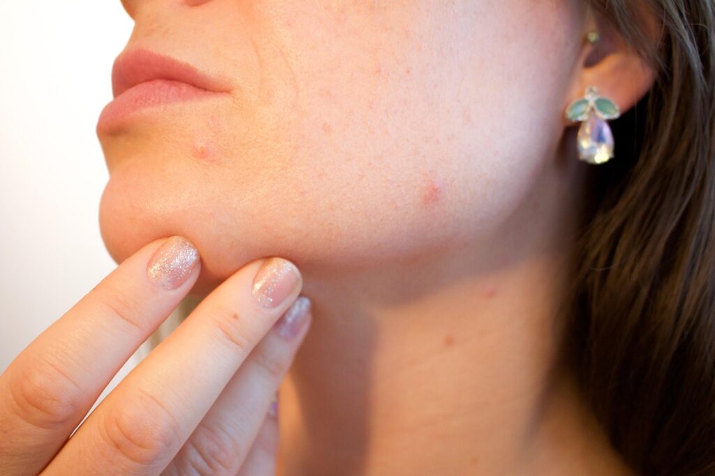 Close-up of a woman's lower face and chin showing mild skin irritation and blemishes, with fingers touching the skin.